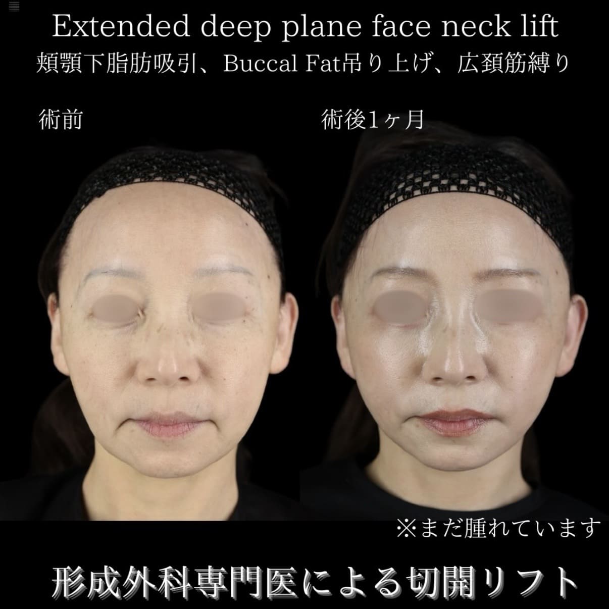 フェイスリフト