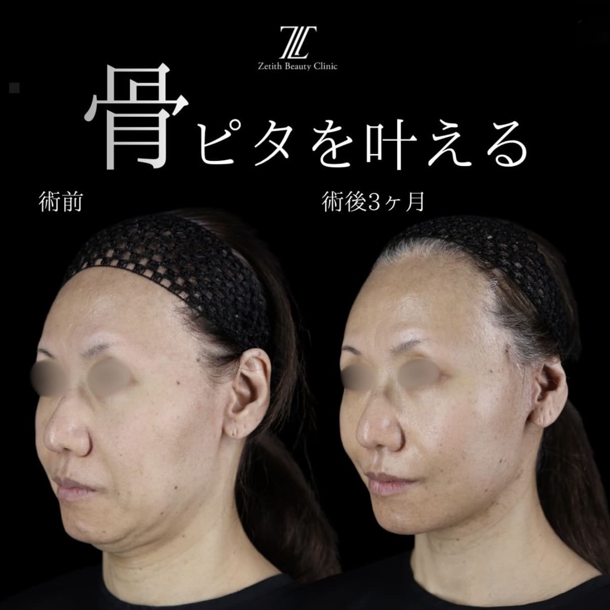 副島医師によるフェイスリフトの術前/術後3ヶ月 施術後 