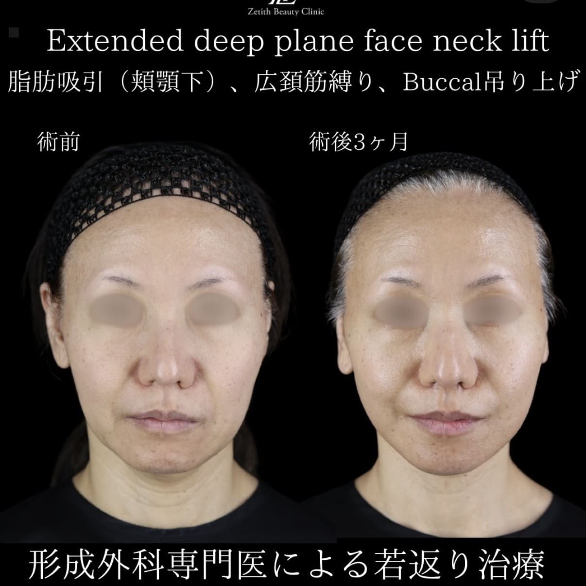 フェイスリフト