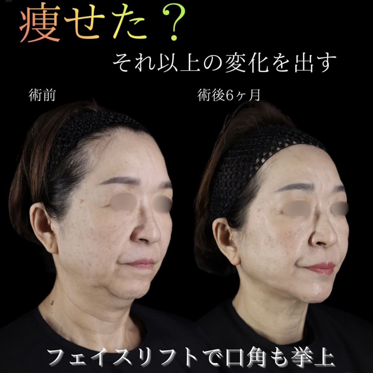 フェイスリフト