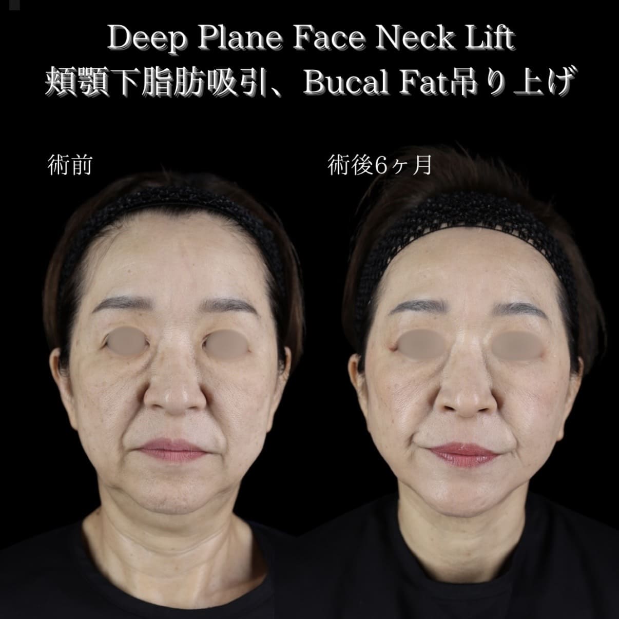 副島医師によるフェイスリフトの術前/術後6ヶ月 施術後 