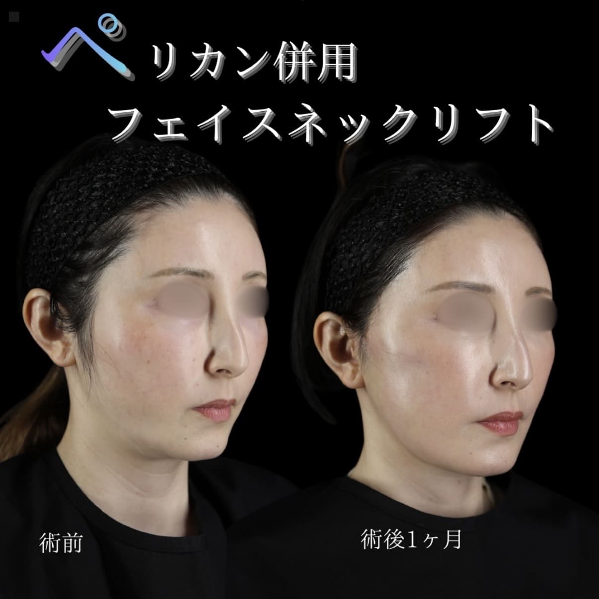 副島医師によるフェイスリフトの術前/術後1ヶ月 施術後 