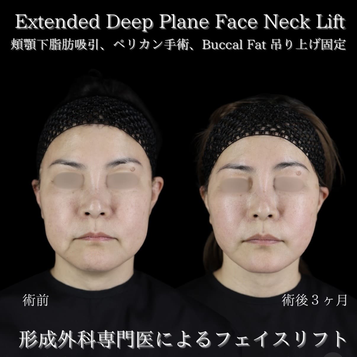 フェイスリフト