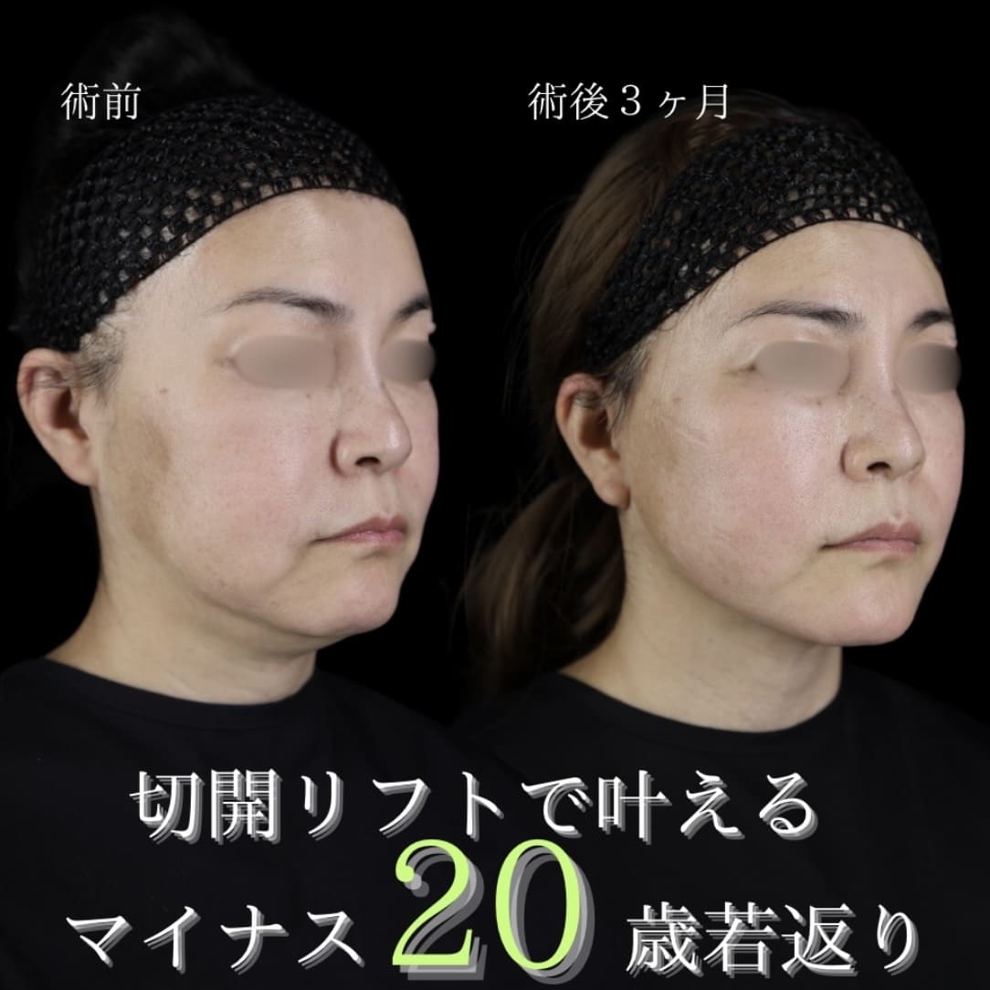副島医師によるフェイスリフトの術前/術後3ヶ月 Sonra 