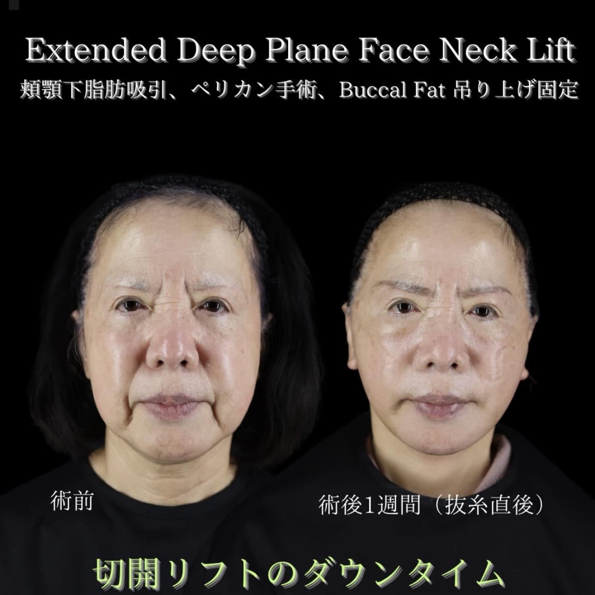 副島医師によるフェイスリフトの術前/術後1週間 施術後 