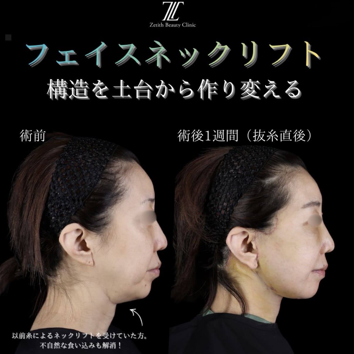 副島医師によるフェイスリフトの術前/術後1週間 施術後 
