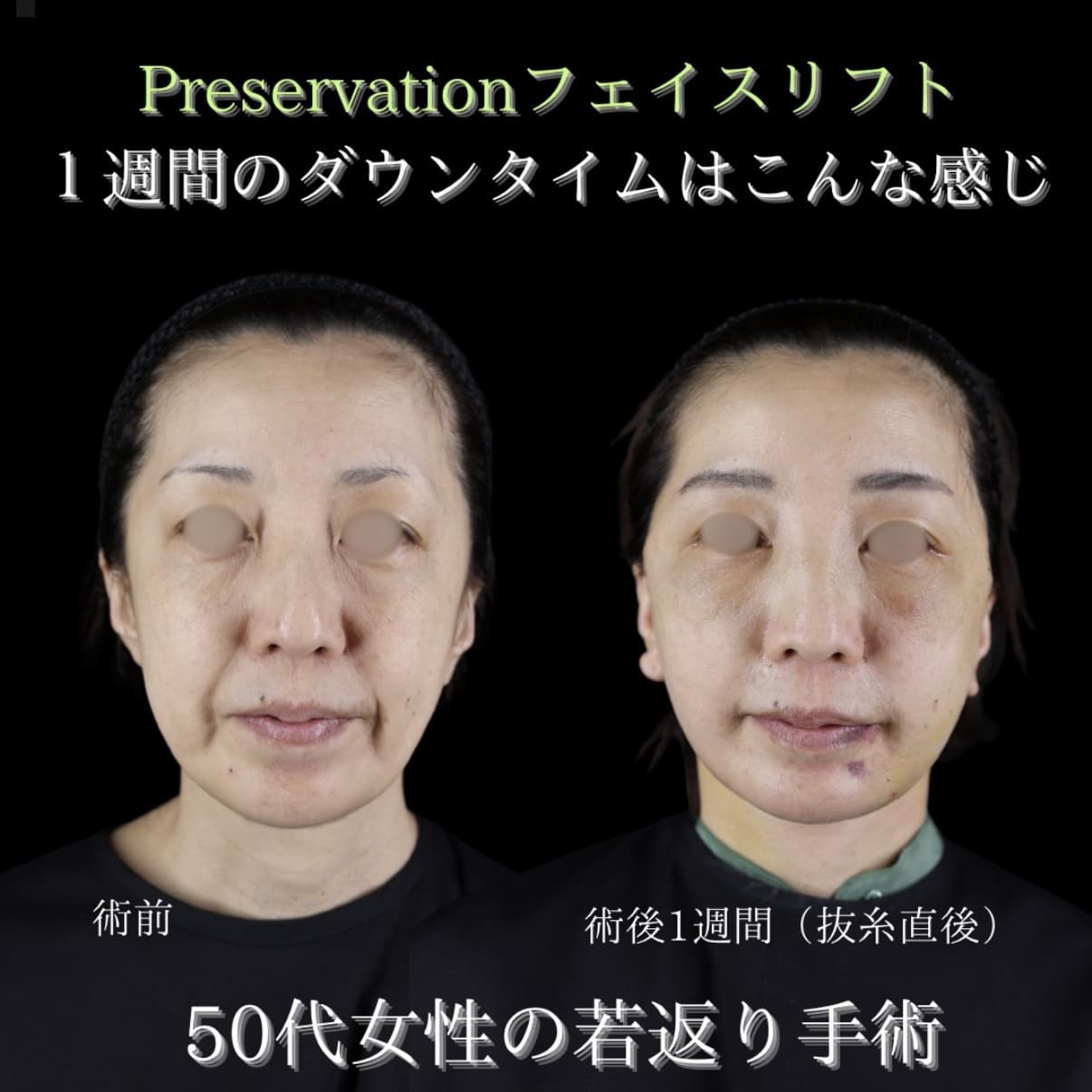 フェイスリフト
