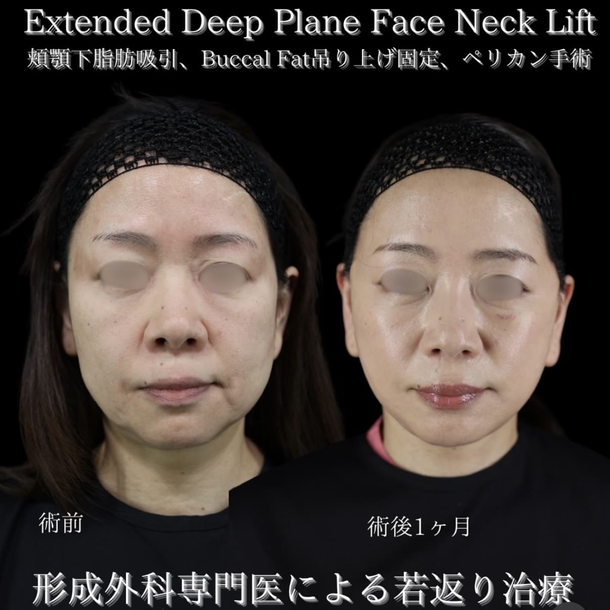 副島医師によるフェイスリフトの術前/術後1ヶ月 Sonra 