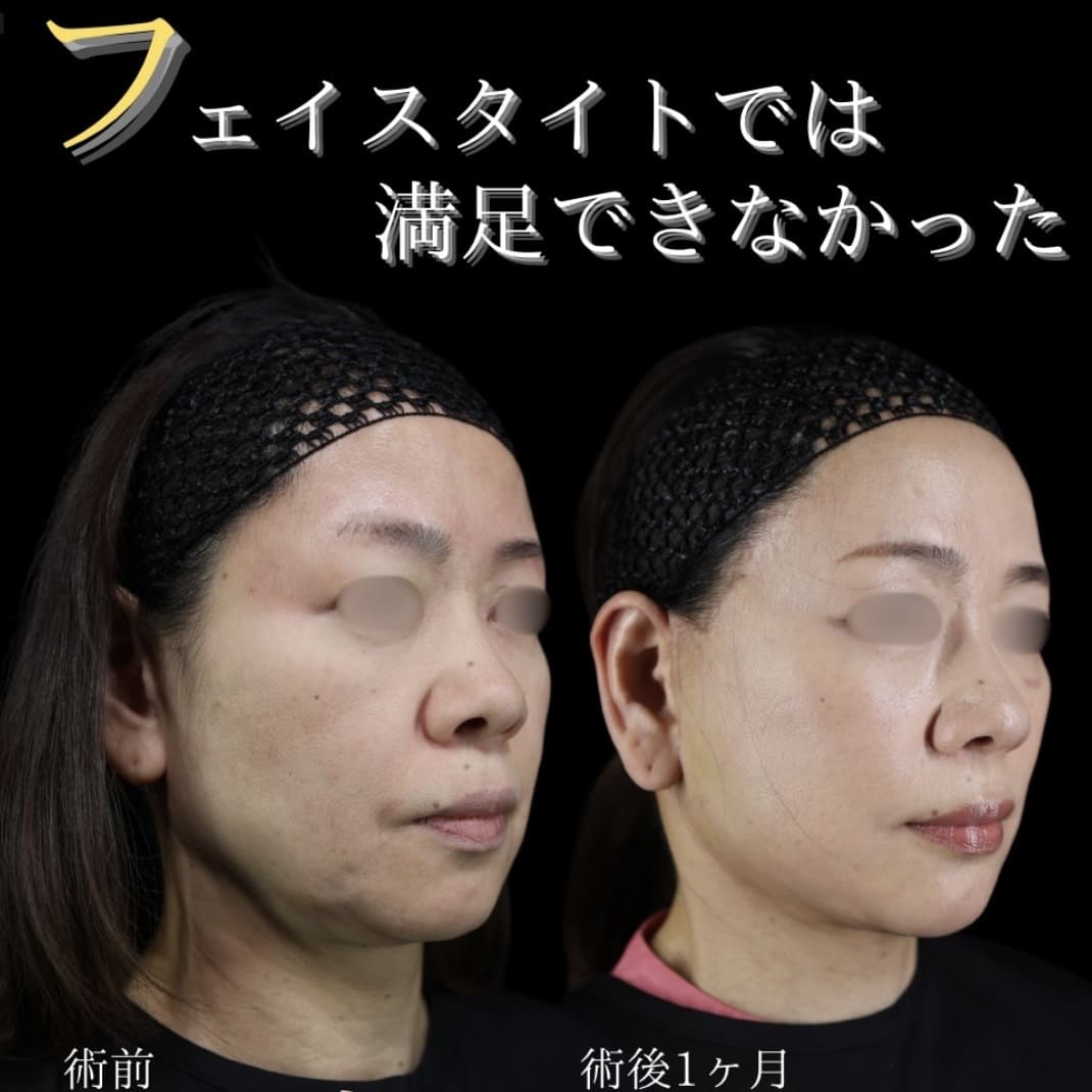 フェイスリフト