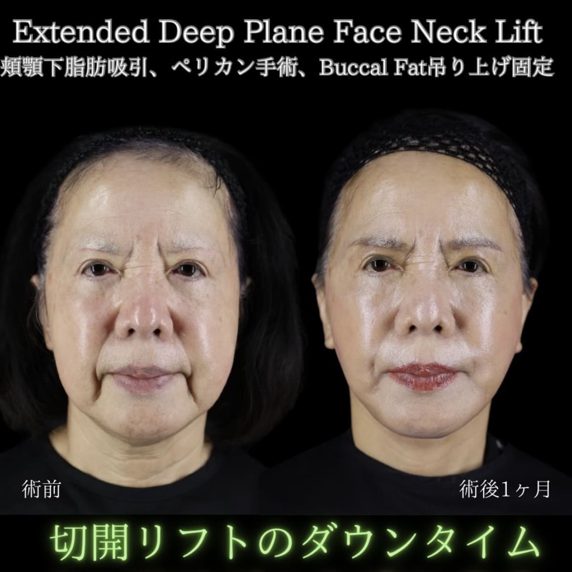 フェイスリフト