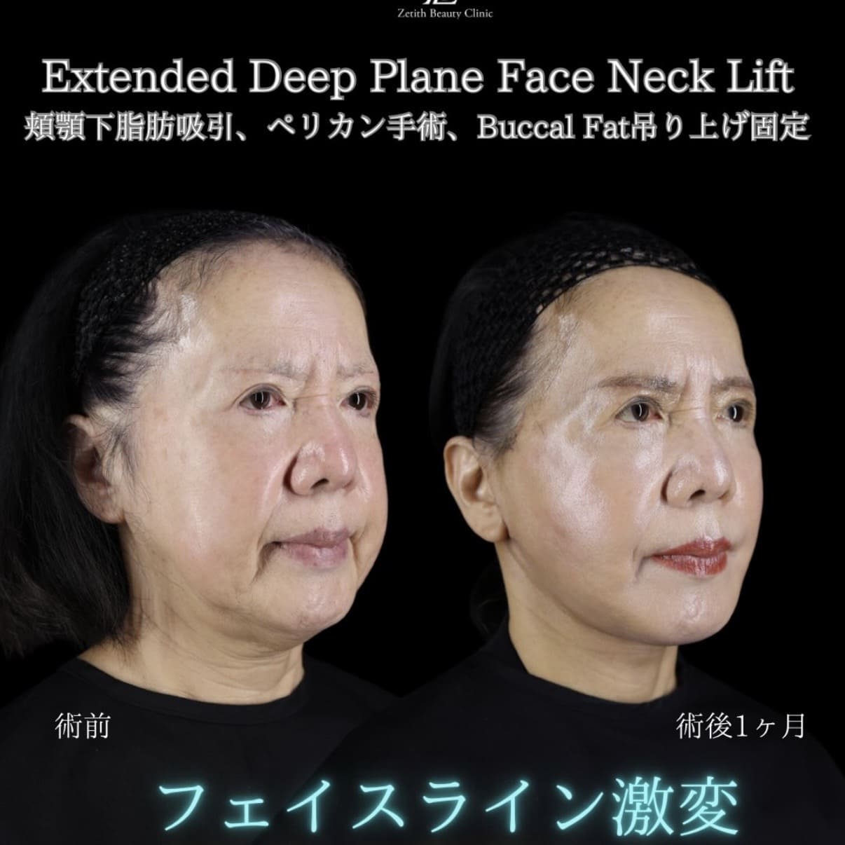 副島医師によるフェイスリフトの術前/術後1ヶ月 Дараа 