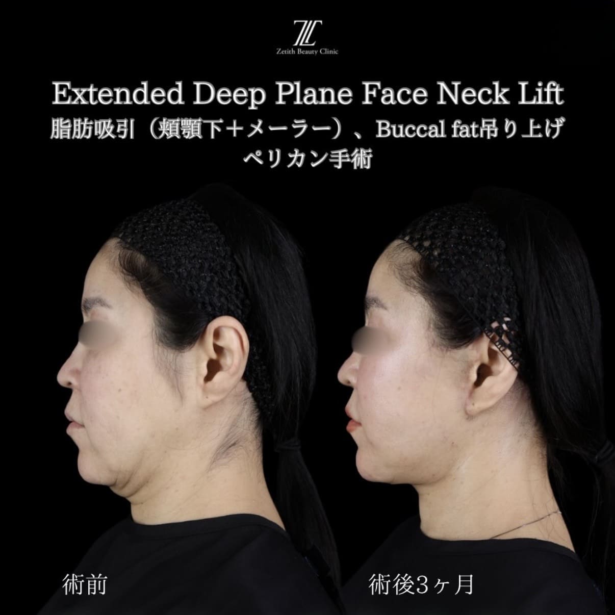 フェイスリフト
