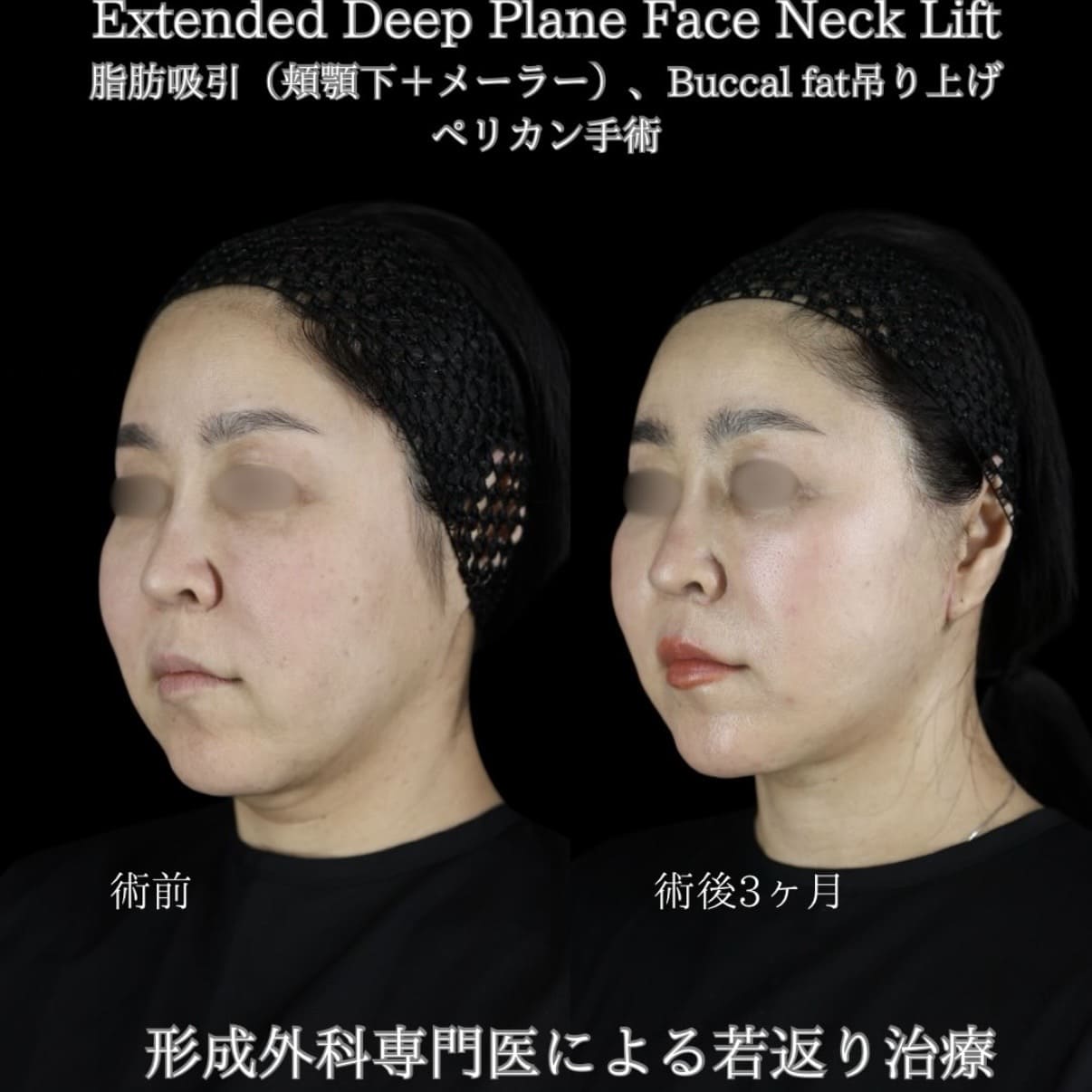 副島医師によるフェイスリフトの術前/術後3ヶ月 Дараа 