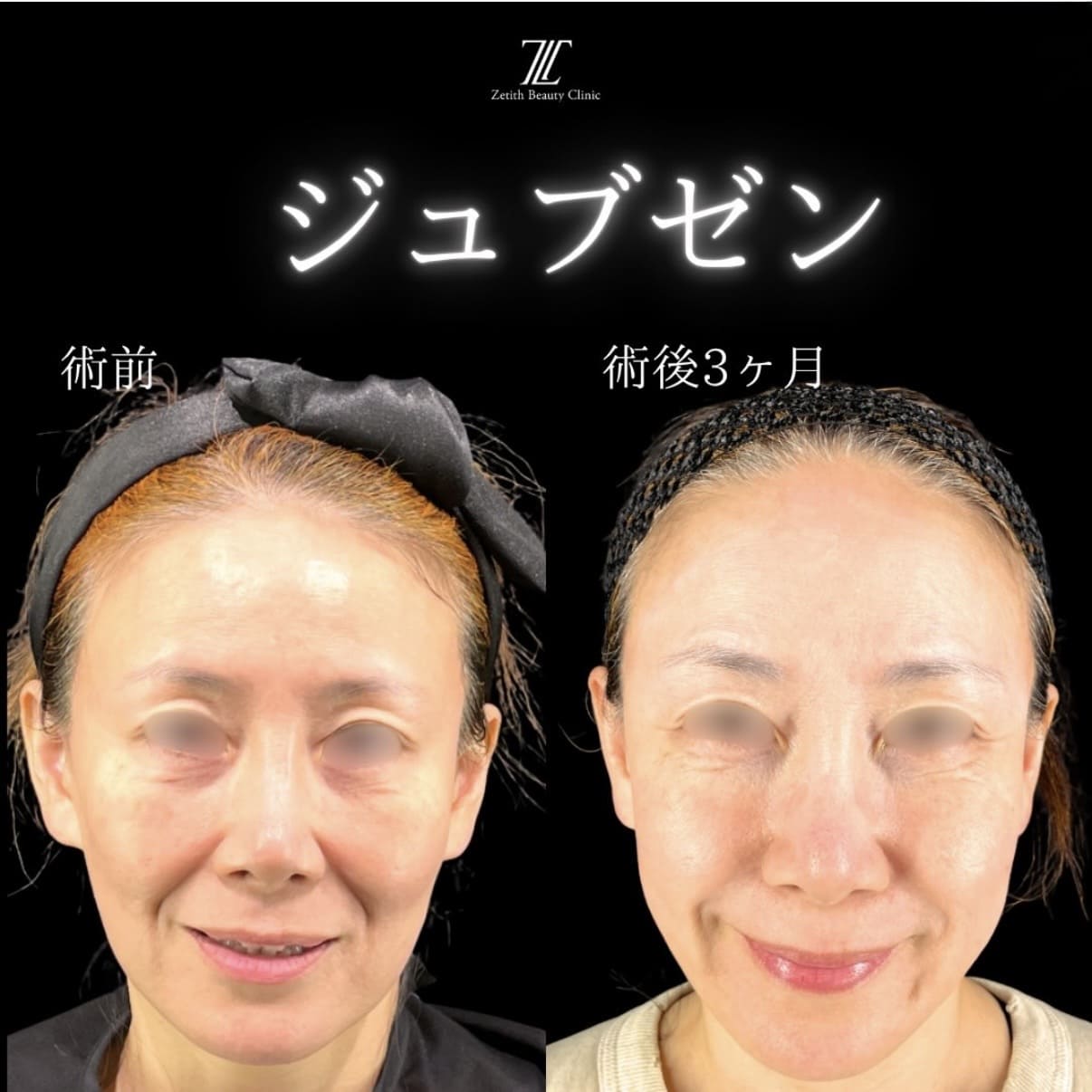 副島医師によるJUVGENの術前/術後3ヶ月 施術後 