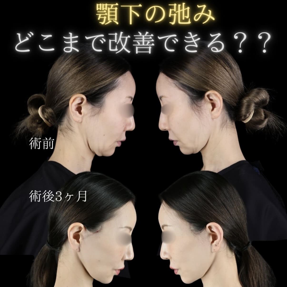 フェイスリフト
