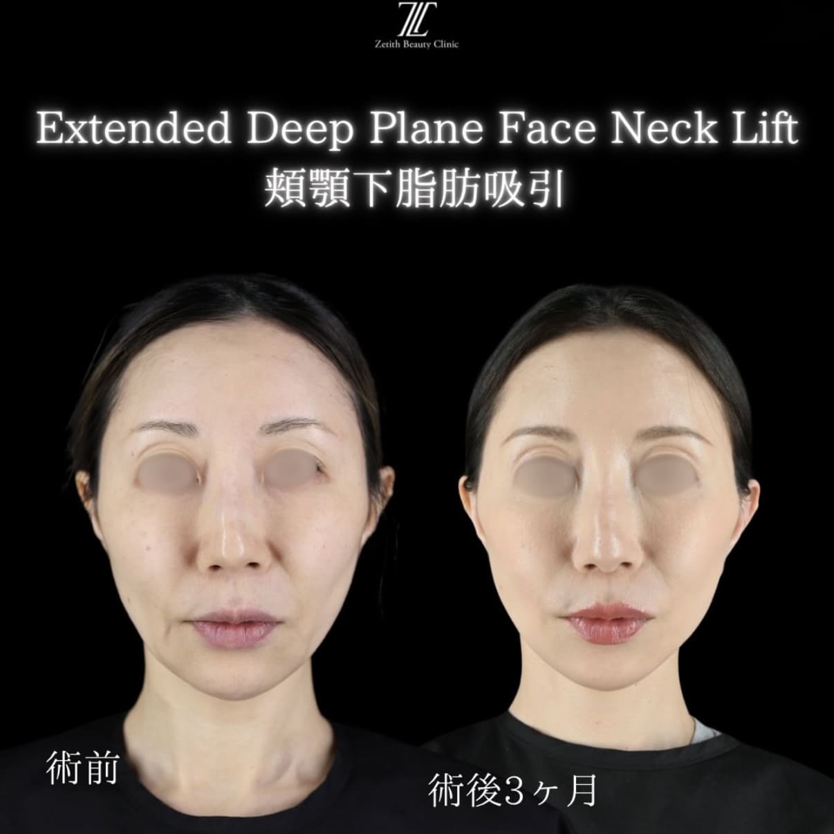 副島医師によるフェイスリフトの術前/術後3ヶ月 After 