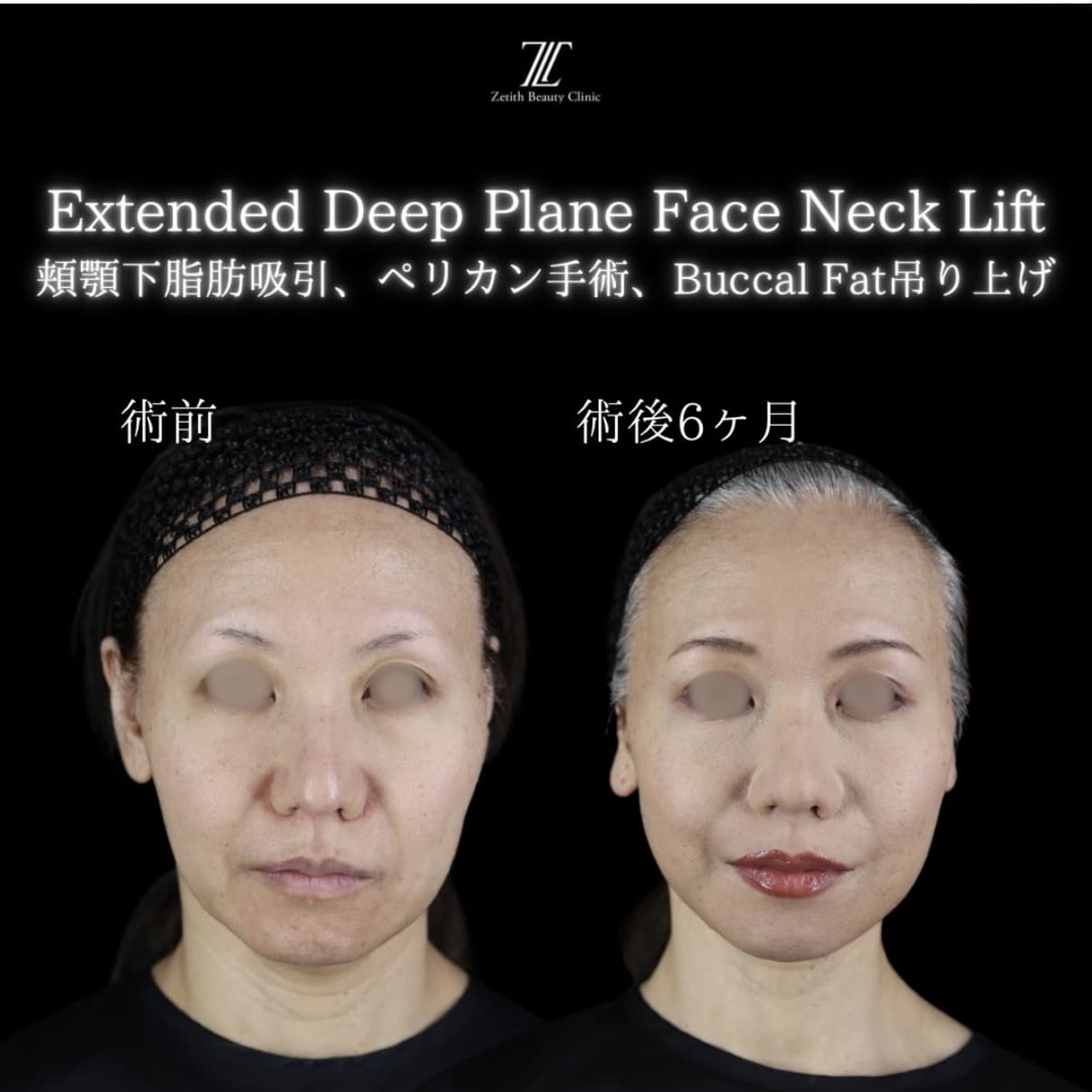 副島医師によるフェイスリフトの術前/術後6ヶ月 施術後 
