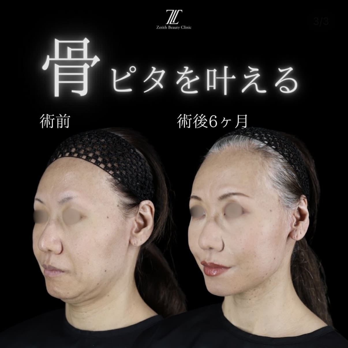 フェイスリフト