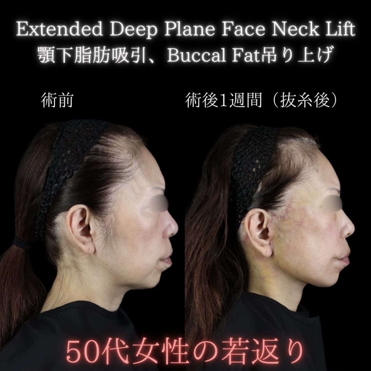 フェイスリフト
