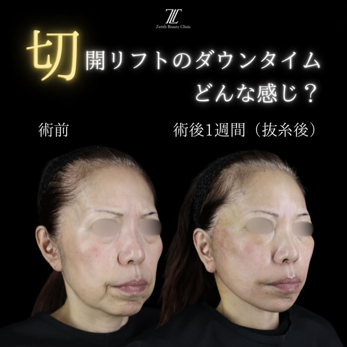 副島医師によるフェイスリフトの術前/術後1週間 بعد 