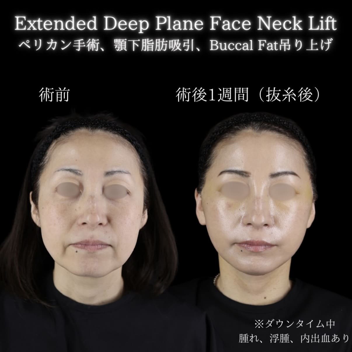 フェイスリフト