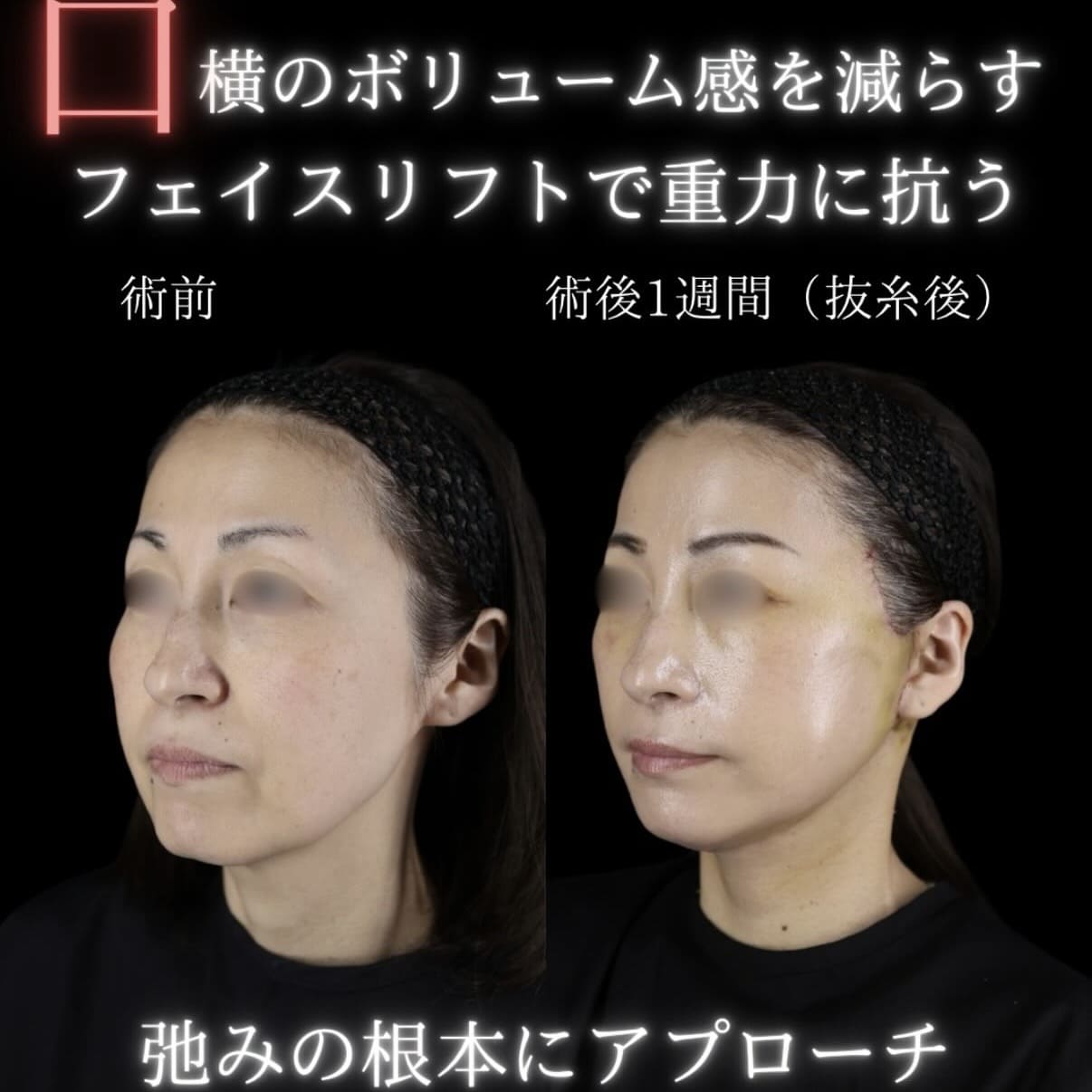 副島医師によるフェイスリフトの術前/術後1週間 بعد 