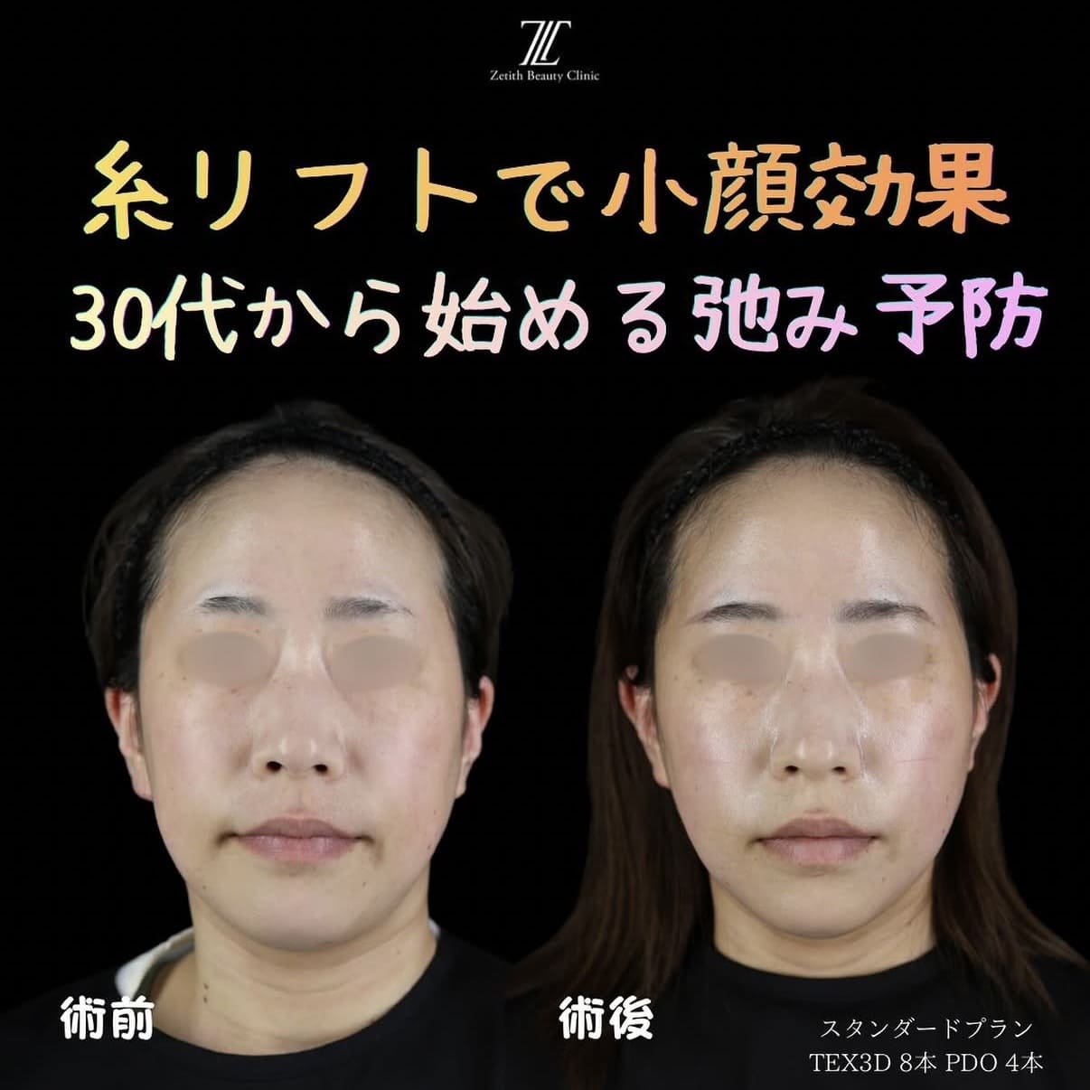 たるみ治療