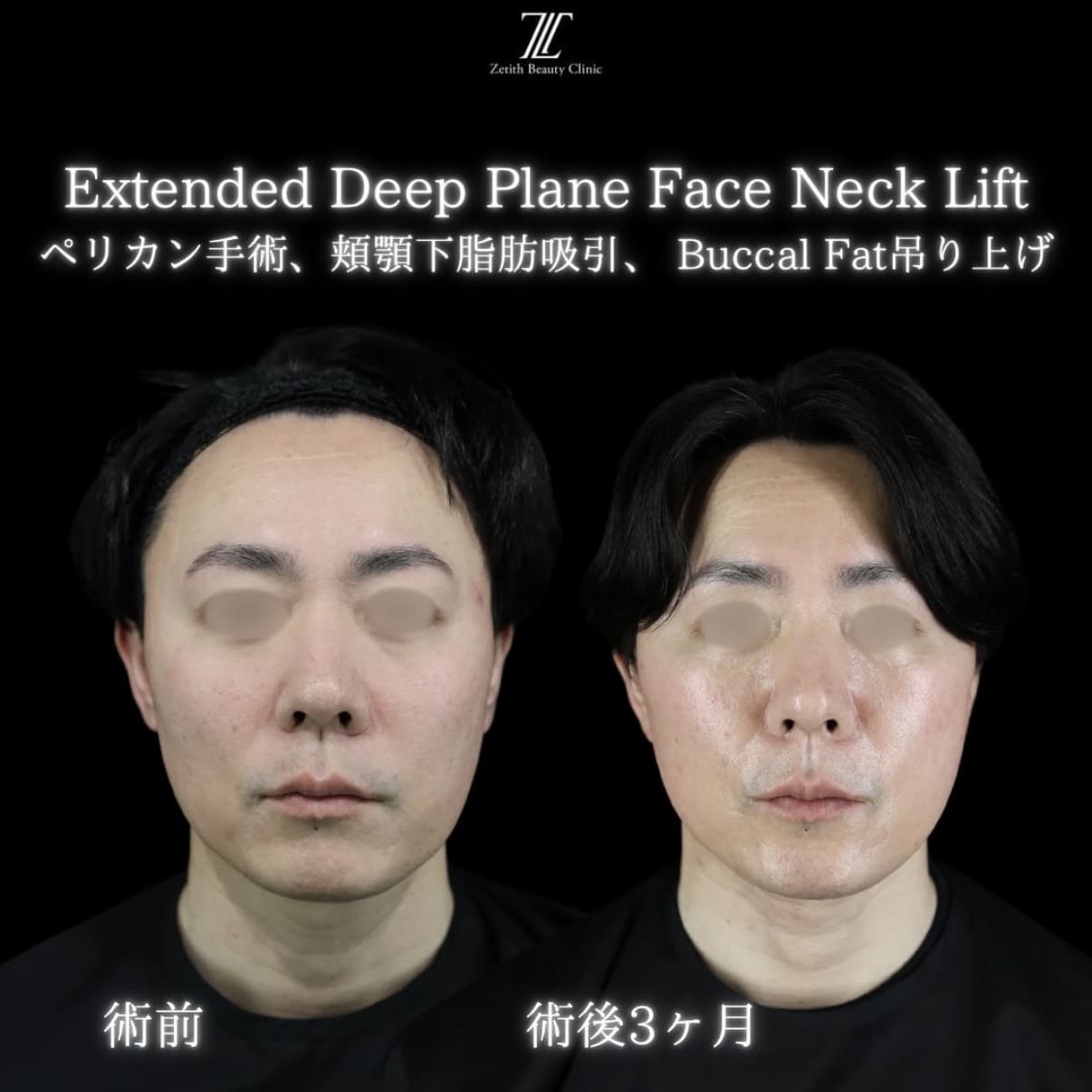 副島医師によるフェイスリフトの術前/術後3ヶ月 بعد 