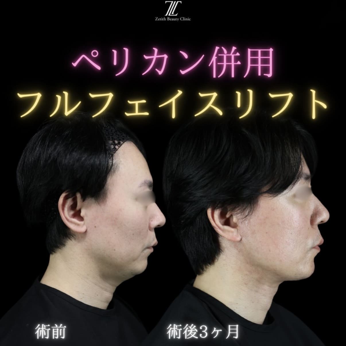 フェイスリフト