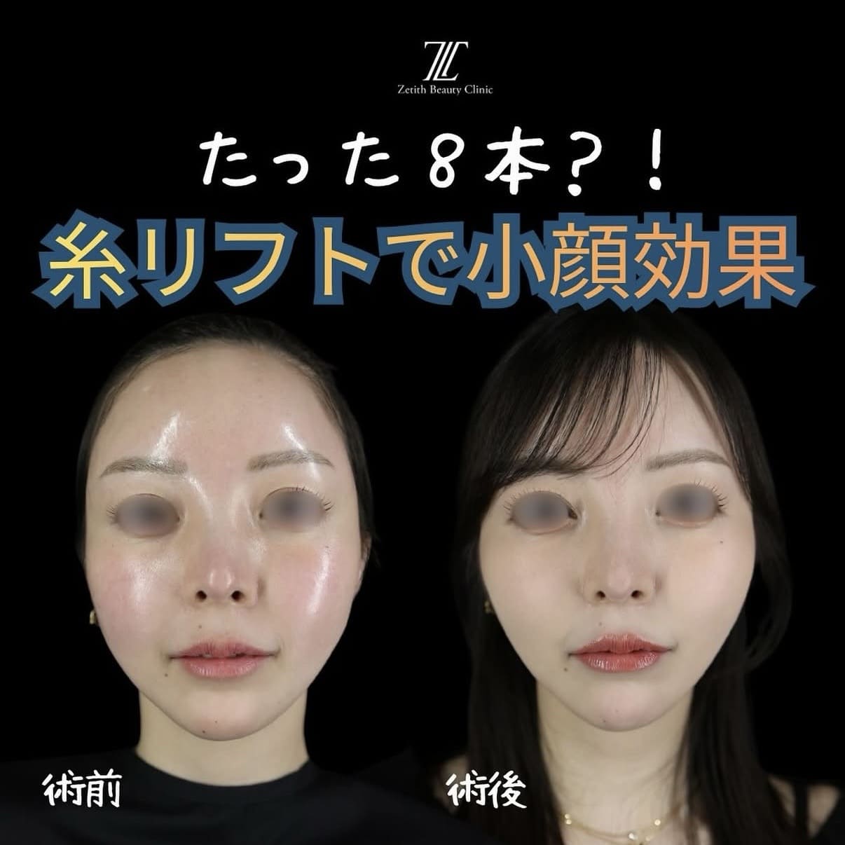 たるみ治療