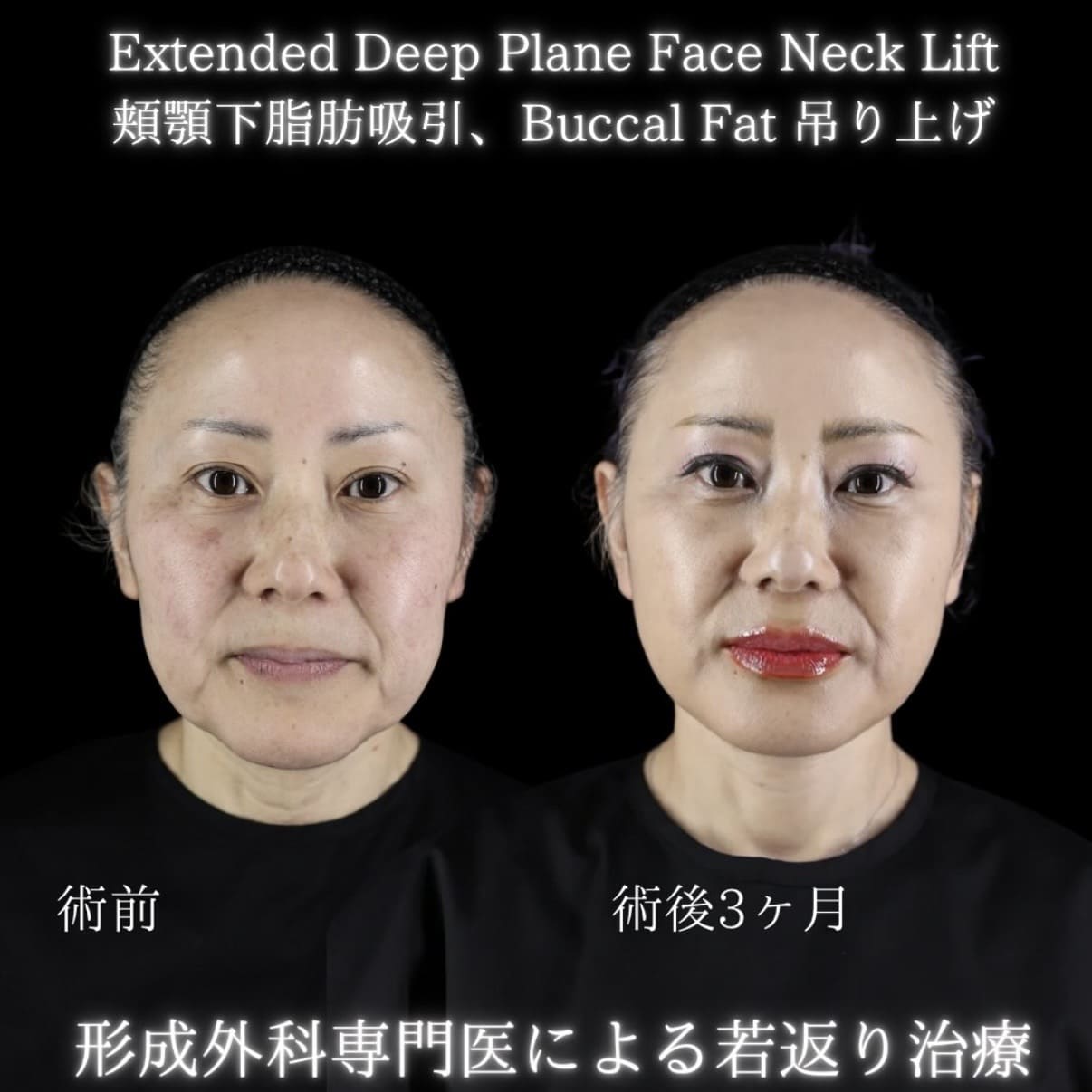 副島医師によるフェイスリフトの術前/術後3ヶ月 施術後 
