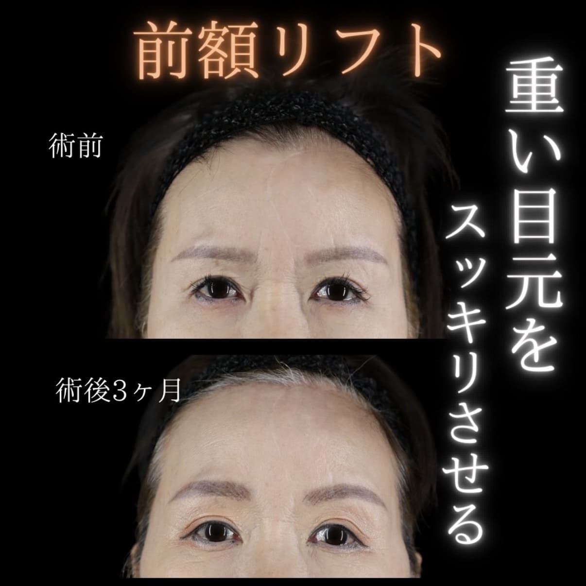 フェイスリフト