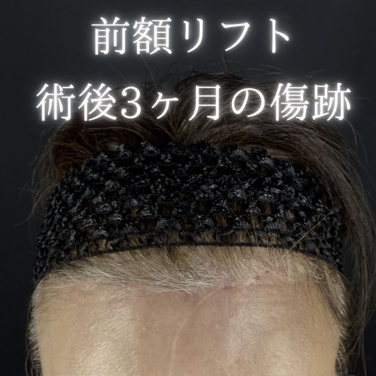 副島医師による前額リフトの術前/術後3ヶ月 بعد 