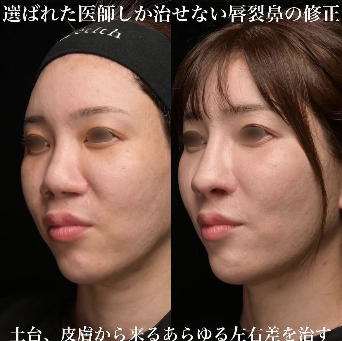 鉄医師による鼻整形の術前/術後1ヶ月 术后 