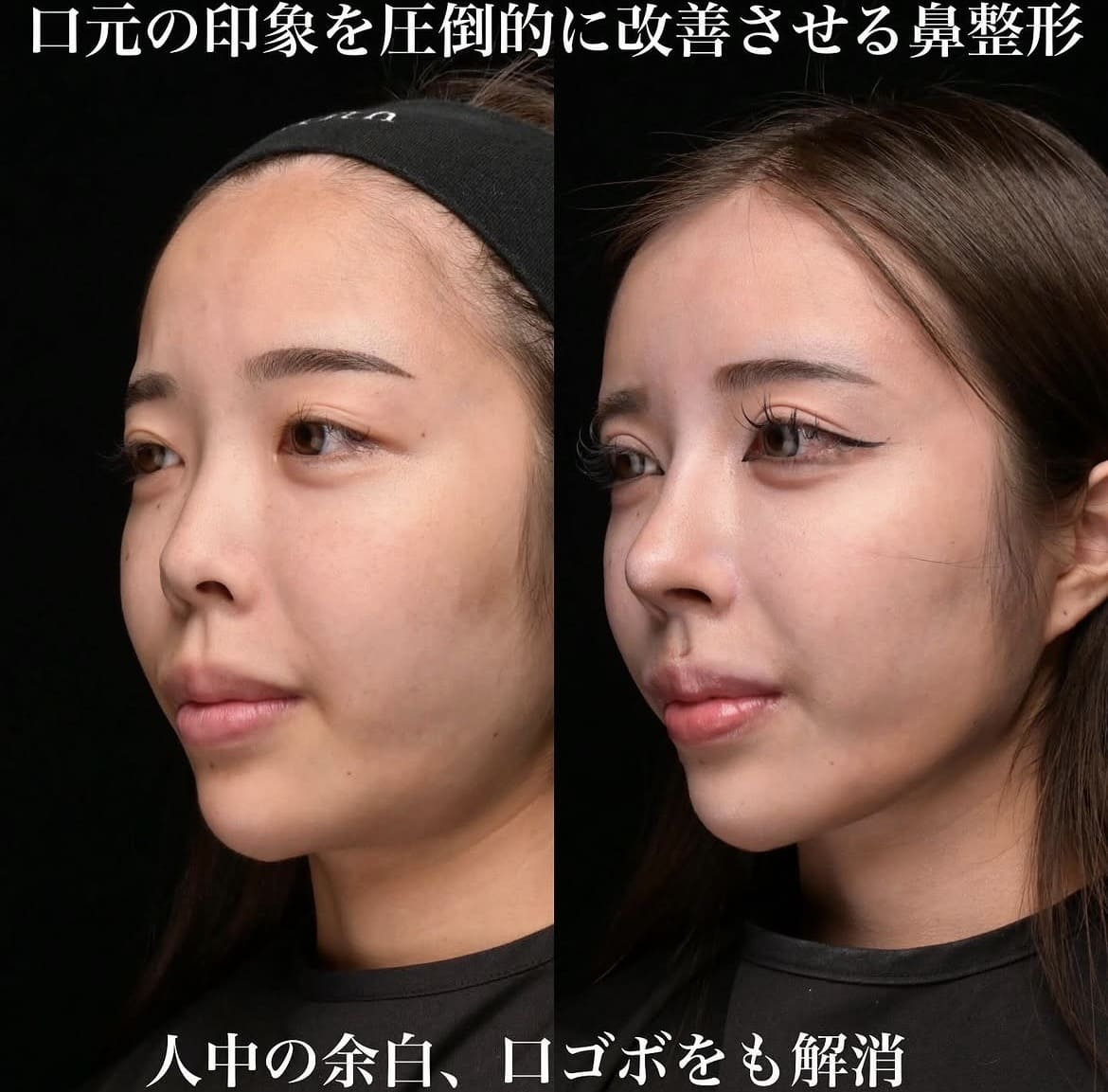 鉄医師による鼻整形術前/術後1ヶ月 术后 