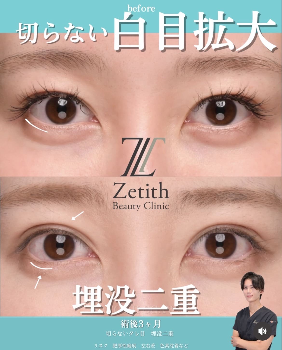 目元整形