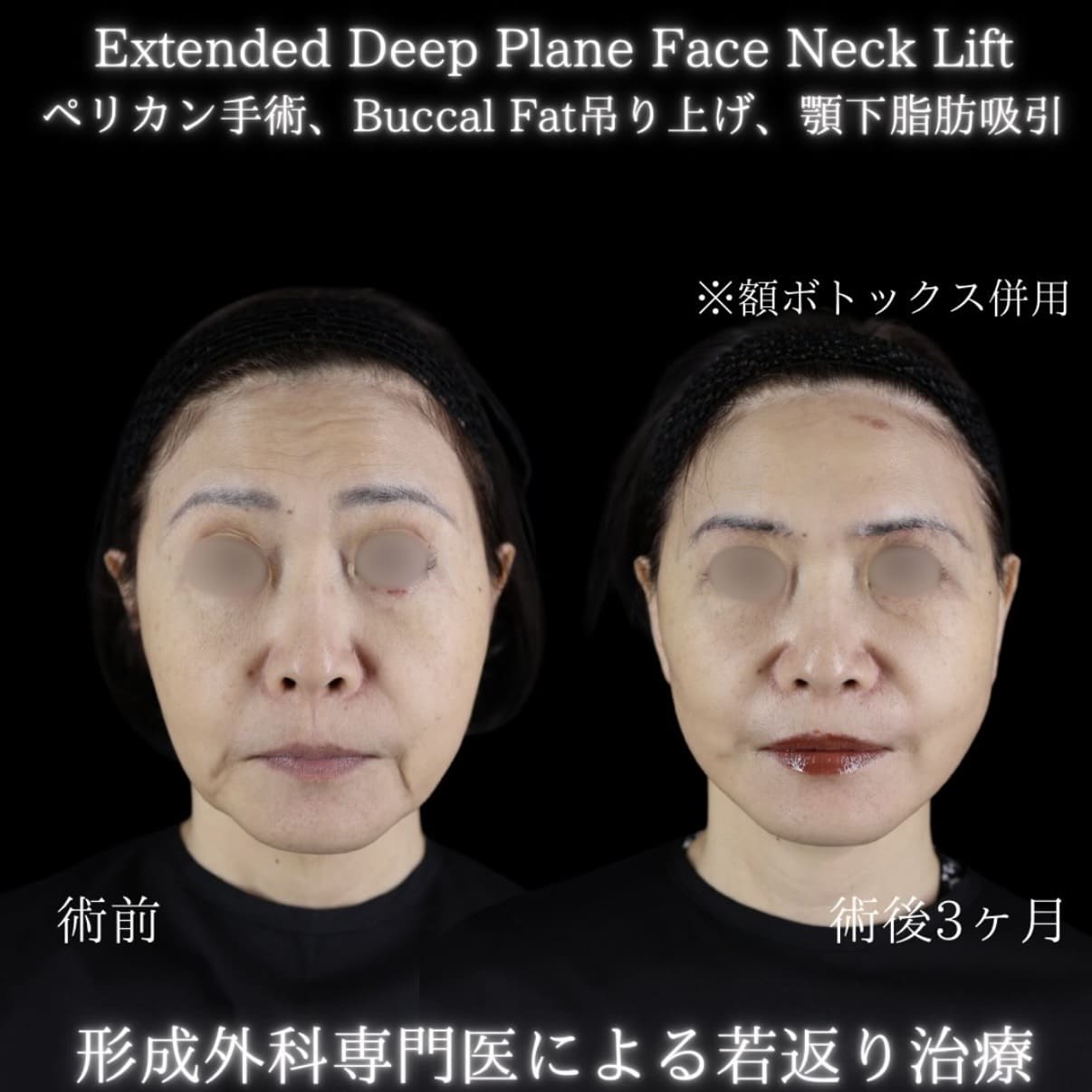 フェイスリフト