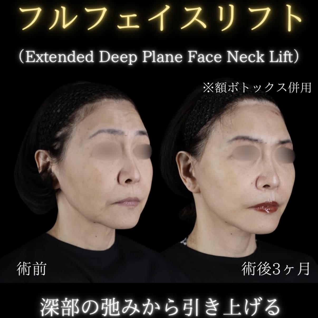副島医師によるフェイスリフトの術前/術後3ヶ月 Sau 