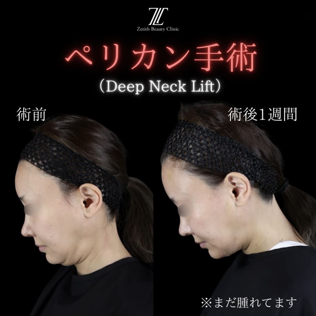 副島医師によるペリカン手術の術前/術後1週間 术后 
