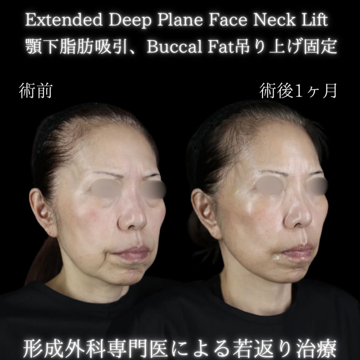 副島医師によるフェイスリフトの術前/術後1ヶ月 | Case Photos