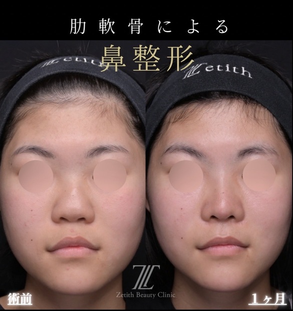鼻整形