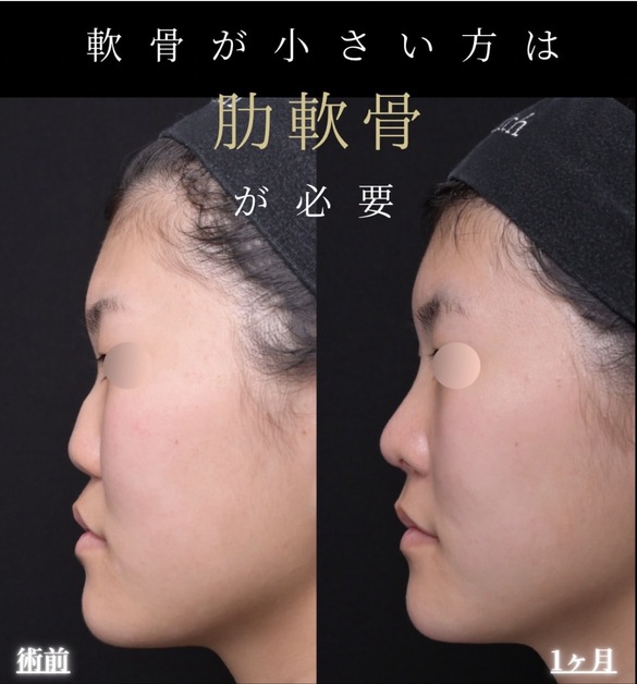 羽根医師による鼻整形術前/術後1ヶ月 术后 