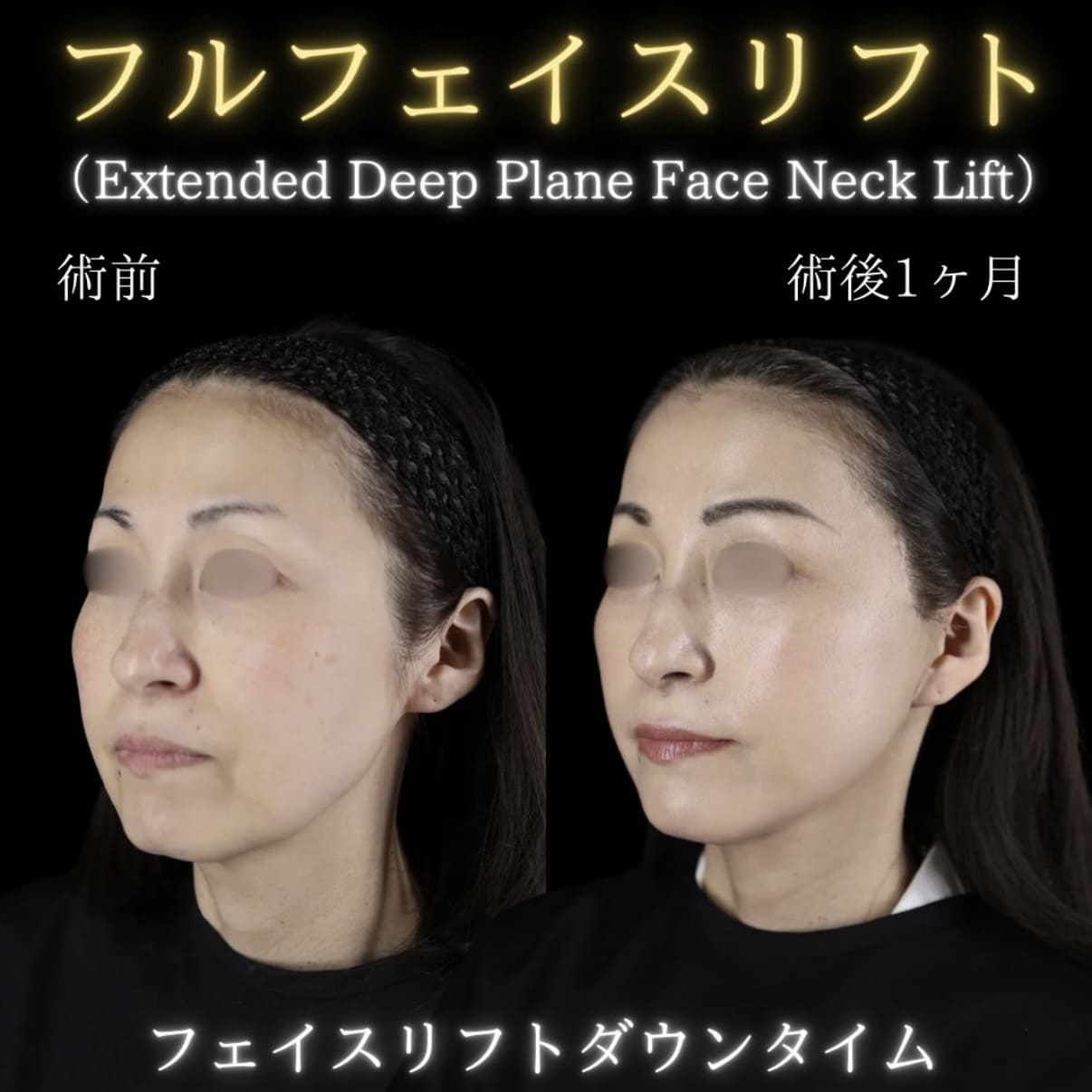 副島医師によるフェイスリフトの術前/術後1ヶ月 بعد 