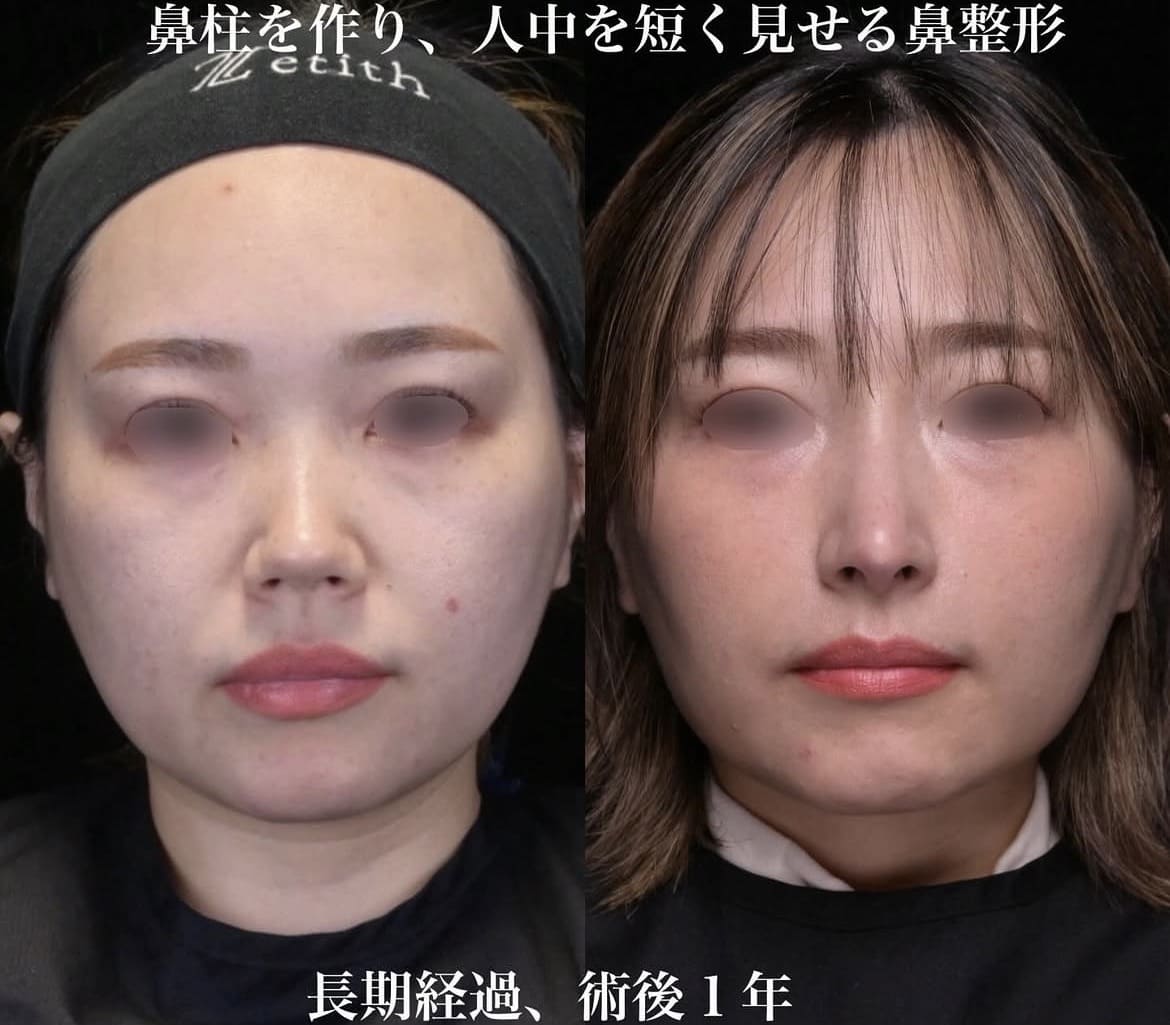 鼻整形
