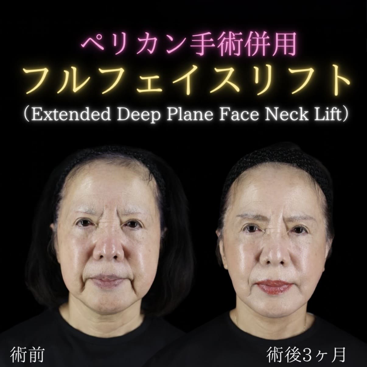 フェイスリフト