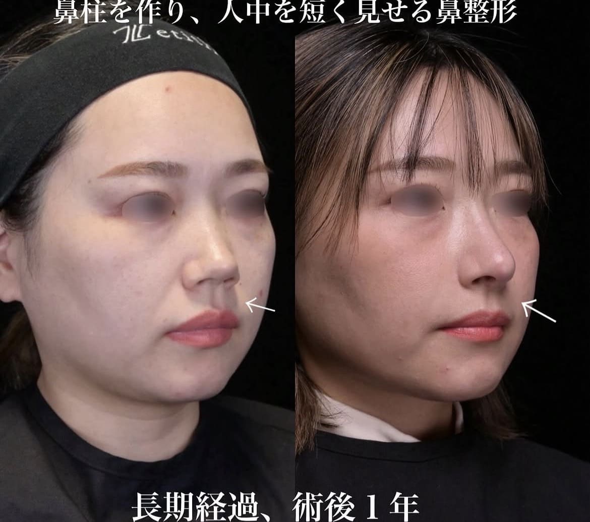 鉄医師による鼻整形術前/術後1年1ヶ月 施術後 