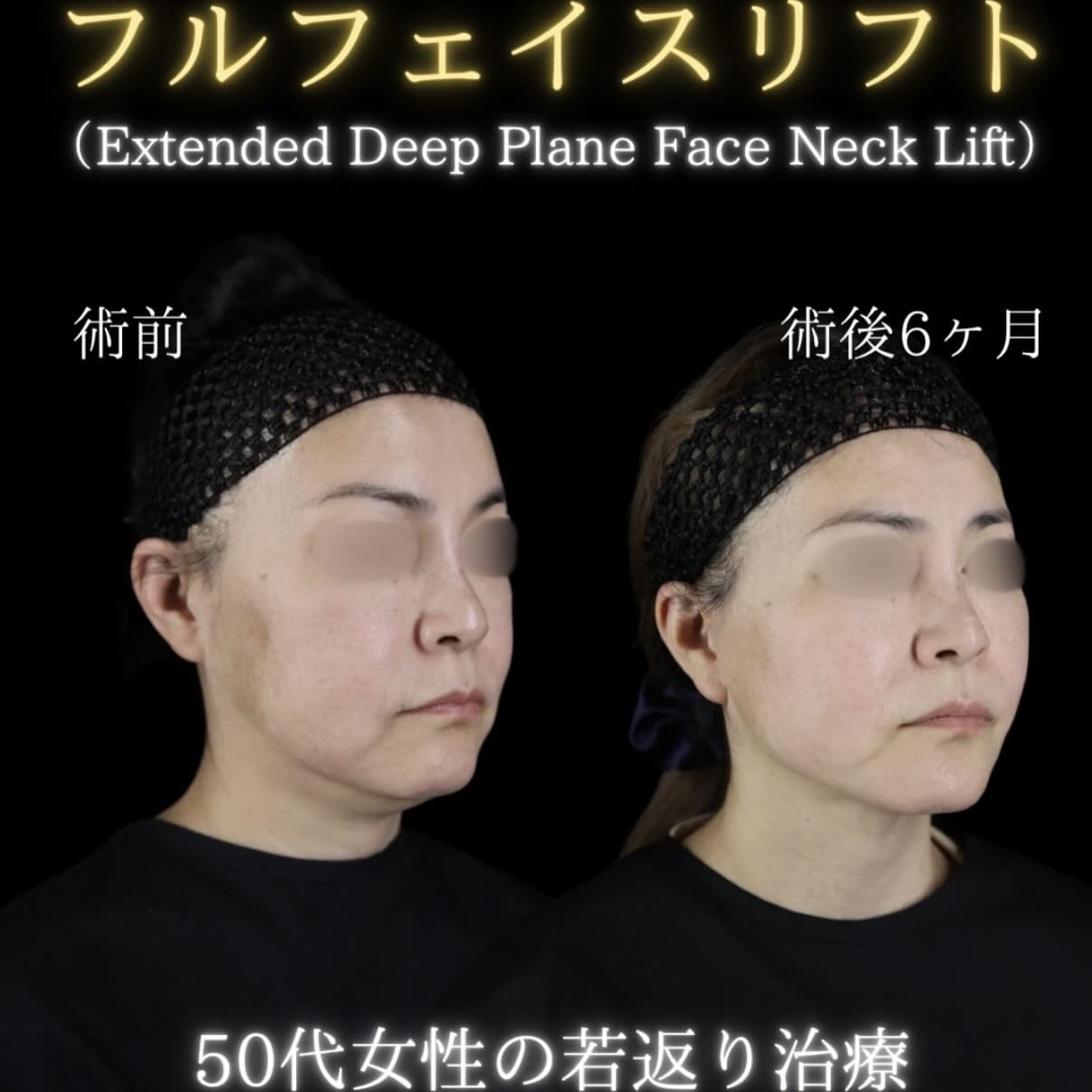 副島医師によるフェイスリフトの術前/術後6ヶ月 | 症例写真 — ゼティス