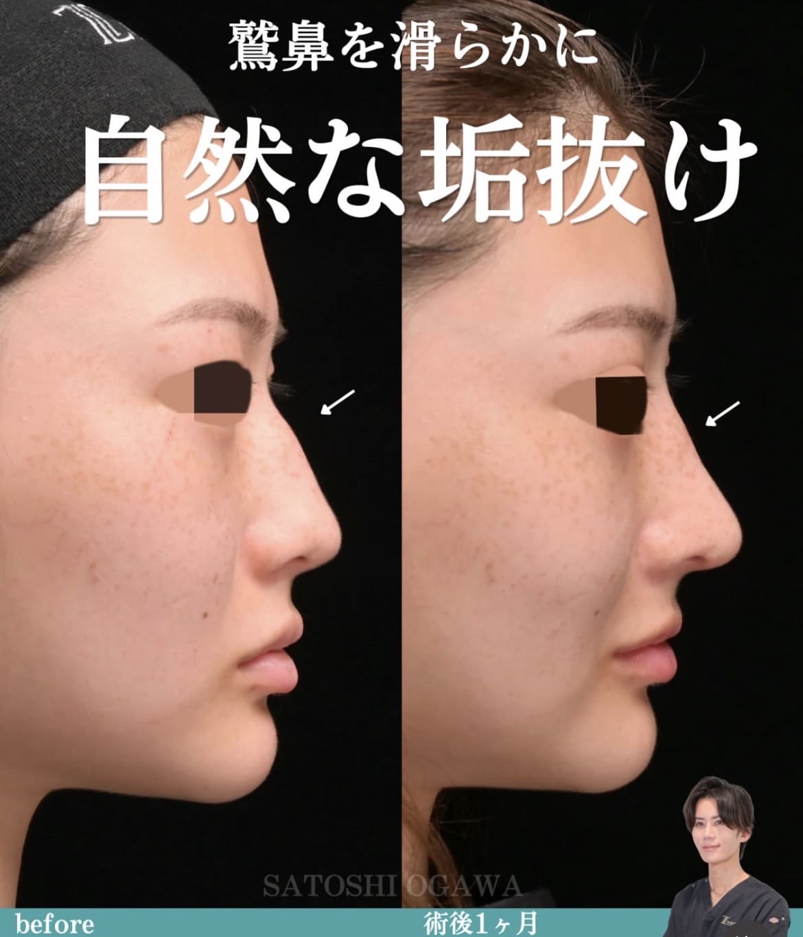小川医師による鼻整形術前/術後1ヶ月 施術後 