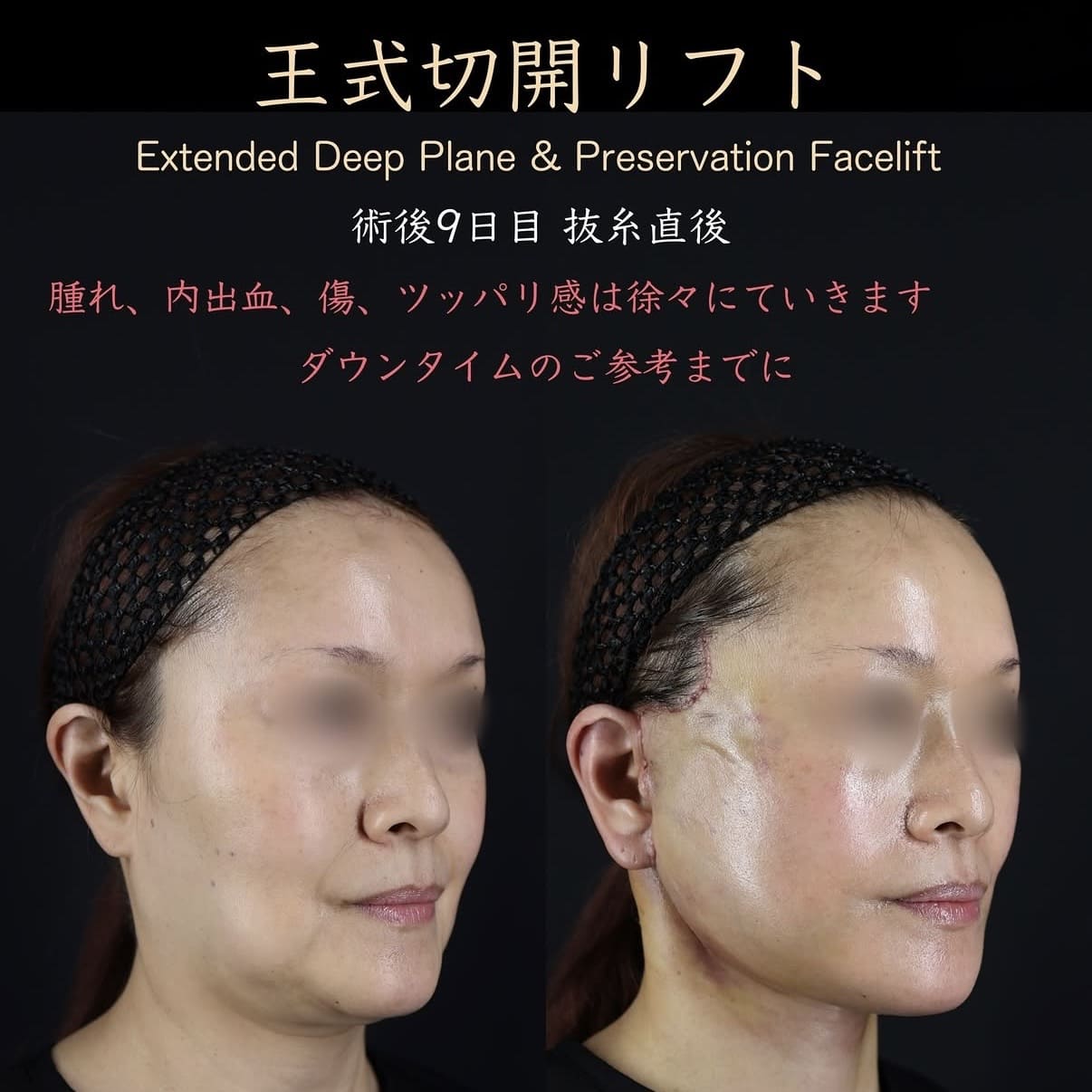 切開リフト