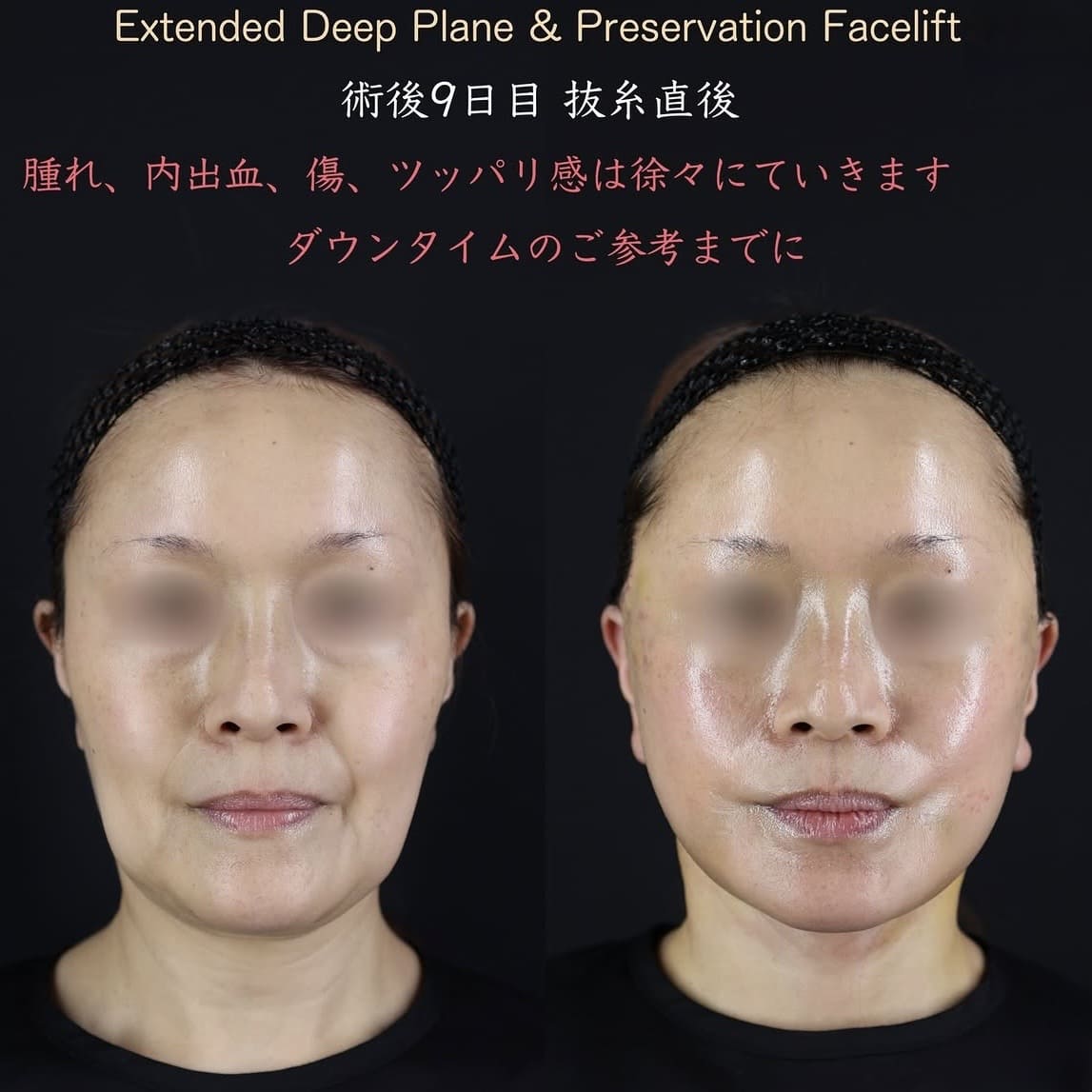 王医師によるフェイスリフトの術前/術後9日目 施術後 